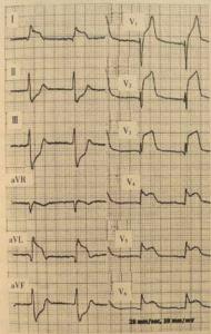 心梗心电图 辨识心电图，高危心梗速诊断！