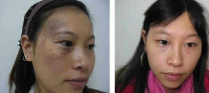 激光美容太田痣 激光美容太田痣 激光美容中心治疗太田痣