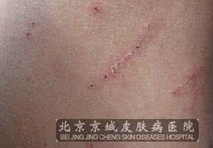 咳嗽久治不愈 久治不愈的皮肤病 皮肤病多年不愈,可能是胃里的细菌“捣乱”