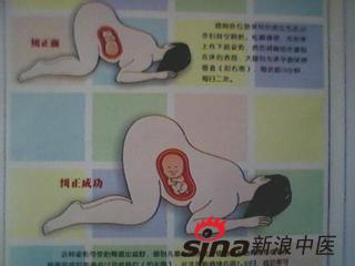 胎位不正38周会转正么 转胎方治疗胎位不正