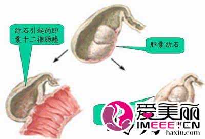 胆结石的饮食注意事项 胆结石饮食注意事项 胆结石不能吃什么？胆结石的饮食注意事项