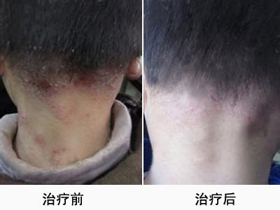 神经性皮炎能不能治疗 神经性皮炎能不能治疗 神经性皮炎真的不能完全根除吗？还有脂肪瘤是怎么回事？