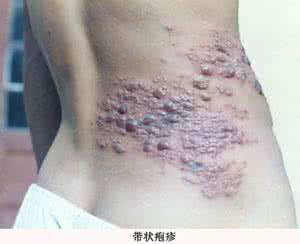 治疗带状疱疹的特效药 妙治?带状疱疹