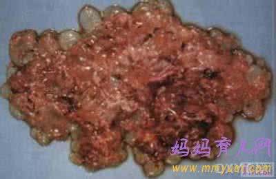 葡萄胎早期症状 葡萄胎早期症状有哪些?早发现更安全