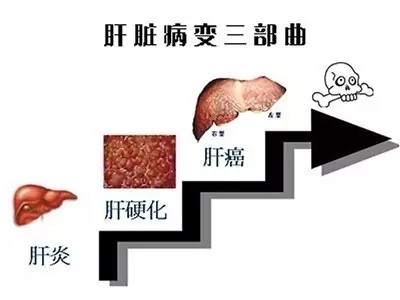慢性肝病包括 图文：急、慢型肝病（不包括乙肝）特效秘方