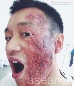 梦见毁容 毁容 梦见毁容_毁容