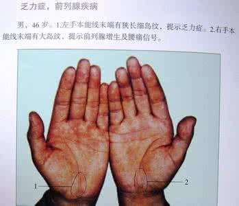 高血压手诊 掌纹诊病：高血压手诊法