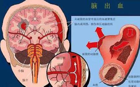 致死致残的罕见病 脑血栓致死致残，6大信号要警惕！中医师一把粉防血栓、护血管！！！