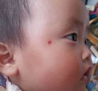 儿童血管瘤挂什么科 儿童血管瘤挂什么科 儿童血管瘤的诊断及检查