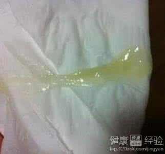 白带粘稠是怎么回事 白带粘稠是怎么回事 白带稠多主要是怎么回事