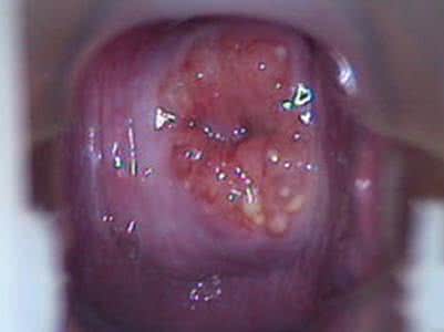 纳氏囊肿是什么引起的 什么是纳氏囊肿 纳氏囊肿的并发症有哪些