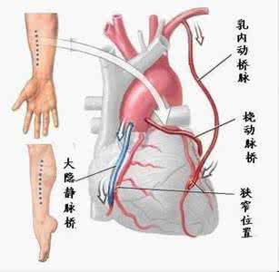 冠状动脉支架手术 冠状动脉支架，岂能一放了之？（持续风险篇）