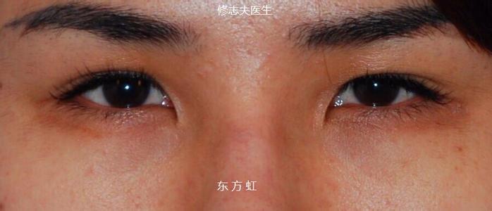 内眦赘皮矫正手术 内眦赘皮矫正手术 内眼角开大手术矫正内眦赘皮要注意什么?