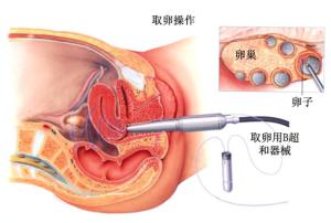 试管取卵前要注意什么 试管取卵前要注意什么 1天取卵2次? 定制化试管促排卵-YingIVF案例分享