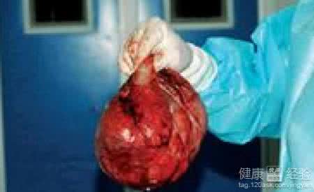 子宫囊肿的治疗方法 子宫囊肿怎么治疗方法 子宫囊肿的治疗方法有什么