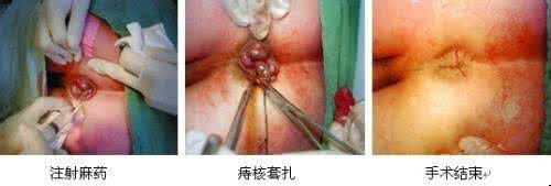 痔疮消肉球秘方 混合痔疮(秘方):
