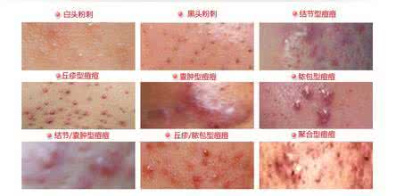医院治疗痤疮多少钱 痤疮医治多少钱 什么方法呢