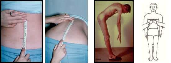 股骨颈骨折的护理问题 强直性脊柱炎的护理问题