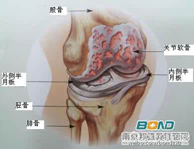 膝关节软骨损伤怎么办 关节骨粘膜损伤怎么办？