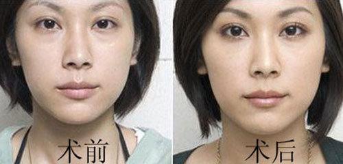 眼袋吸脂需要多少钱 吸脂去眼袋 吸脂去眼袋需要多少钱?