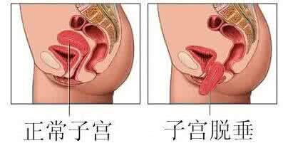 子宫脱垂图片大全 子宫脱垂的症状