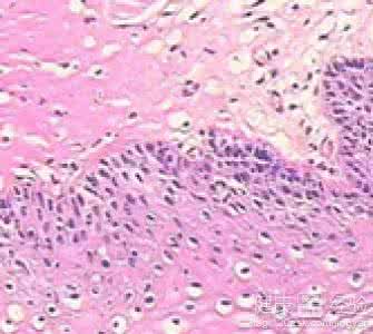 尖锐湿疣好治吗 这样治疗尖锐湿疣比较好