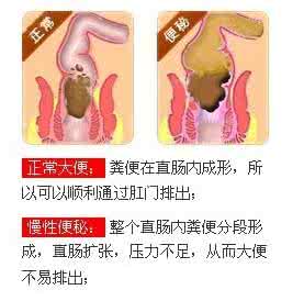 治疗便秘最快的方法 便秘的症状
