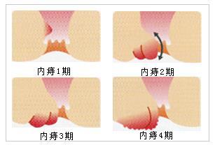 内痔脱出如何治疗 内痔脱出 内痔脱出如何治疗