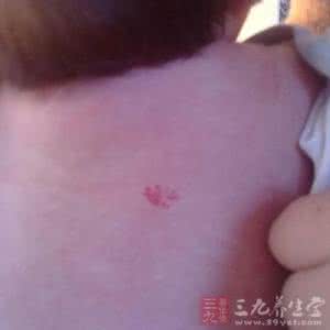 新生儿粪便出现奶瓣 新生儿手上出现这个恐截肢