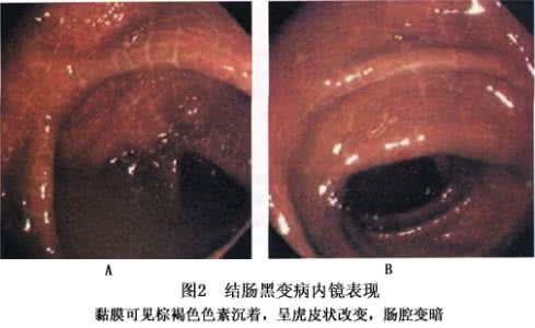 结肠黑变病的治疗 结肠黑变病 这些因素导致的结肠黑变病