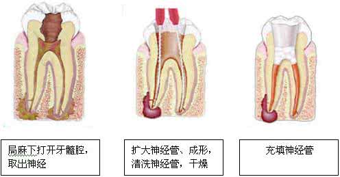 急性牙髓炎的应急处理 牙髓炎怎么办 患上牙髓炎应该这样处理