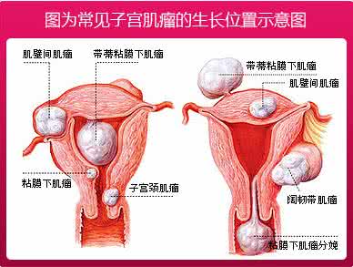 治疗子宫肌瘤的危害 治疗子宫肌瘤的危害 子宫肌瘤不治疗会有哪些危害