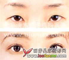 重睑术 重睑术 生理性重睑术完全档案