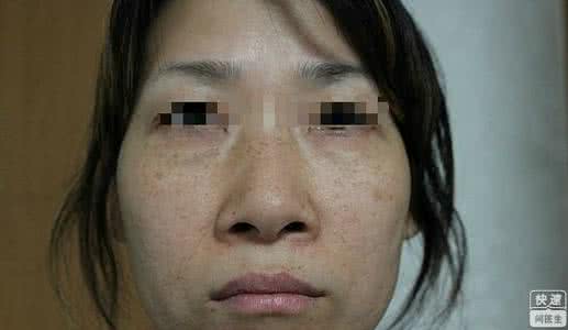 黄褐斑激光治疗 黄褐斑 黄褐斑激光治疗