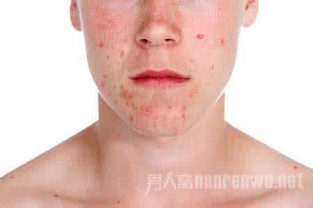 炎症性痤疮 炎症性痤疮 如何治疗炎症性痤疮