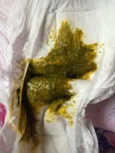 母乳宝宝拉绿屎怎么办 宝宝拉绿屎了怎么办