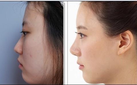 隆鼻手术多少钱 隆鼻 隆鼻手术