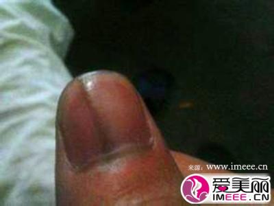 手指甲出现黑色竖纹 手指甲上有黑色竖纹 手指甲上有竖纹怎么办？指甲上有黑色竖纹是怎么回事