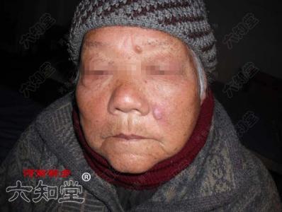 粉瘤中医治疗小偏方 粉瘤中医治疗小偏方 中医治疗寻麻疹 4个小偏方来帮忙
