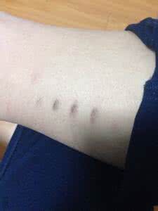 飞行员伤疤 为什么飞行员身上不能有明显的伤疤？