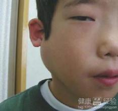 腮腺炎 屡试屡效方 腮腺炎屡试屡效方