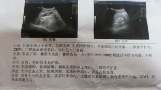 胆囊息肉引起的原因 胆囊息肉引起的原因 胆囊息肉原因 是什么引起的胆囊息肉