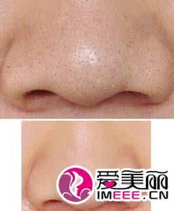 教你去除黑头的妙招 教您几个消掉黑头的妙招