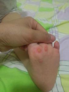 丘疹性荨麻疹治疗方法 丘疹性荨麻疹治疗 治丘疹性荨麻疹三大方法