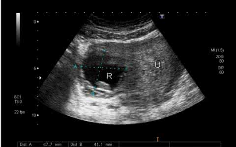 胚囊大小与孕周 胚囊