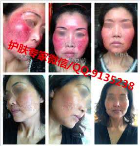 激素脸如何治疗 激素脸如何治疗 “激素脸”是什么?如何治疗“激素脸”