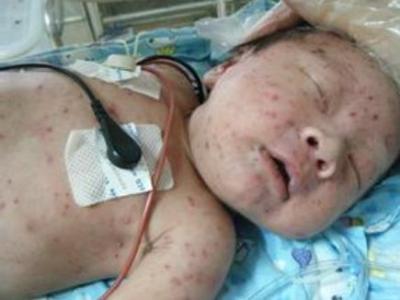 吃螃蟹嘴唇肿 吃了个螃蟹，3岁男孩下体肿如球！不少家长都会忽略这件事