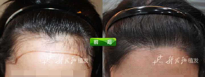 植发价格贵不贵 植发价格贵不贵 红纹石价格贵不贵