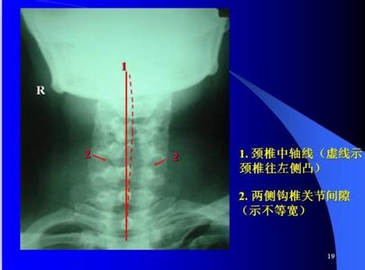 小针刀治疗颈椎病 颈椎阅片的基础知识【针刀医生必备】