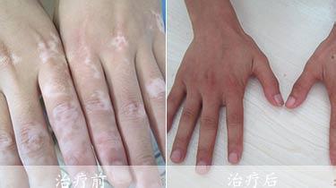 怎么科学的治疗脱发 白癜风治疗 白癜风的科学治疗